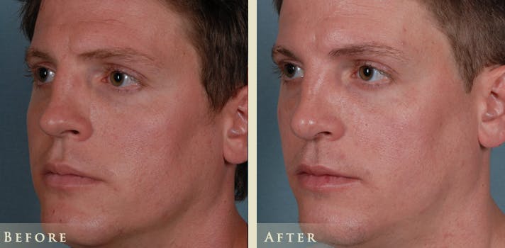 Reconstructive Rhinoplasty Before & After Gallery - Patient 180489 - Image 2