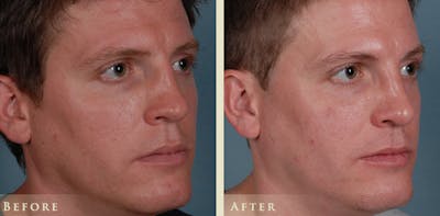 Reconstructive Rhinoplasty Before & After Gallery - Patient 180489 - Image 3