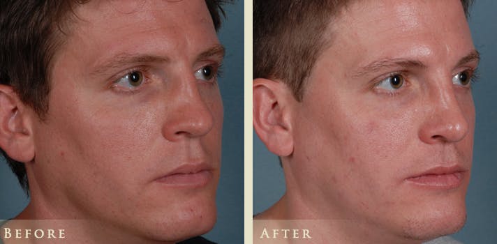 Reconstructive Rhinoplasty Before & After Gallery - Patient 180489 - Image 3