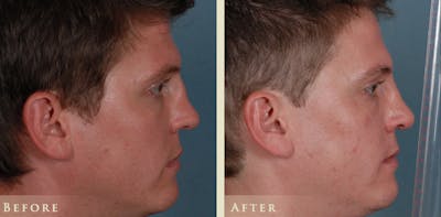 Reconstructive Rhinoplasty Before & After Gallery - Patient 180489 - Image 4