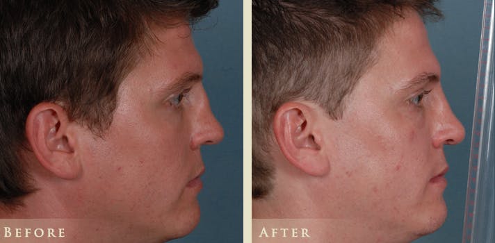 Reconstructive Rhinoplasty Before & After Gallery - Patient 180489 - Image 4
