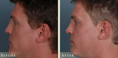 Reconstructive Rhinoplasty Before & After Gallery - Patient 180489 - Image 5