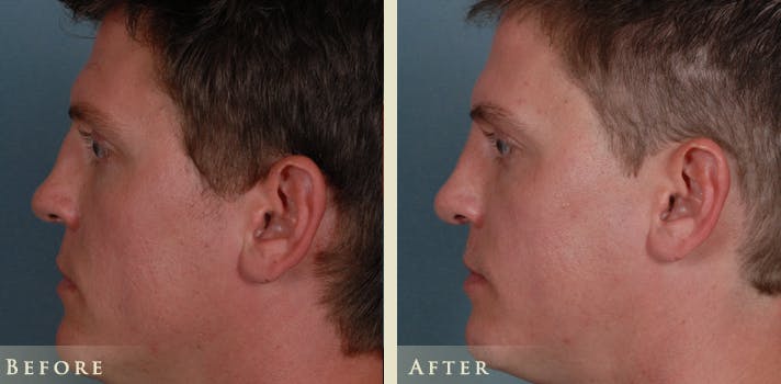 Reconstructive Rhinoplasty Before & After Gallery - Patient 180489 - Image 5