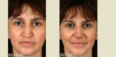 Reconstructive Rhinoplasty Before & After Gallery - Patient 247441 - Image 1