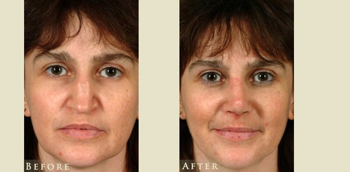 Reconstructive Rhinoplasty Before & After Gallery - Patient 247441 - Image 1