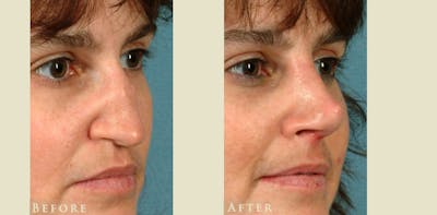 Reconstructive Rhinoplasty Before & After Gallery - Patient 247441 - Image 2
