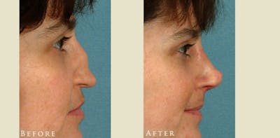 Reconstructive Rhinoplasty Before & After Gallery - Patient 247441 - Image 3