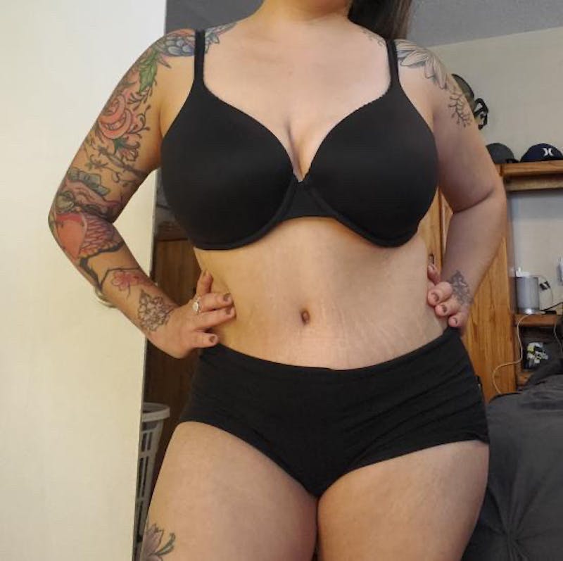 Selfie Gallery Before & After Gallery - Patient 427777 - Image 1