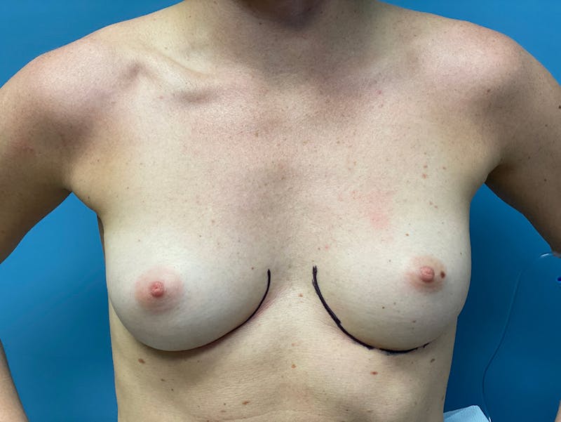 Selfie Gallery Before & After Gallery - Patient 285973 - Image 1