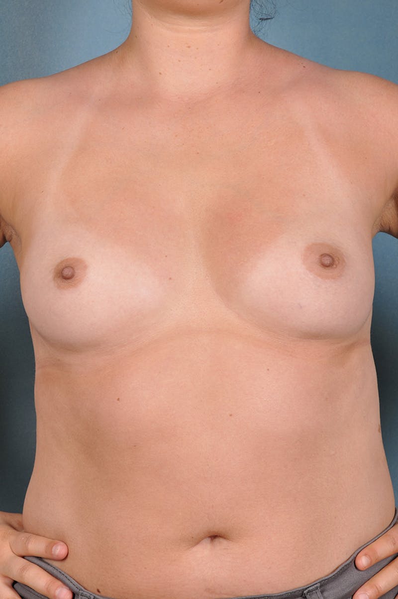 Selfie Gallery Before & After Gallery - Patient 387090 - Image 1