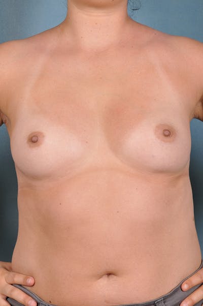 Selfie Gallery Before & After Gallery - Patient 387090 - Image 1