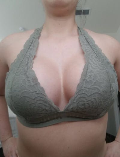 Selfie Gallery Before & After Gallery - Patient 387090 - Image 2