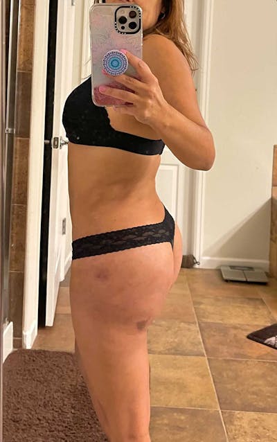 Selfie Gallery Before & After Gallery - Patient 233899 - Image 2