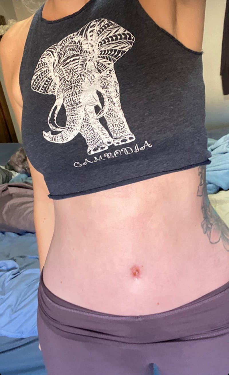 Selfie Gallery Before & After Gallery - Patient 162289 - Image 2