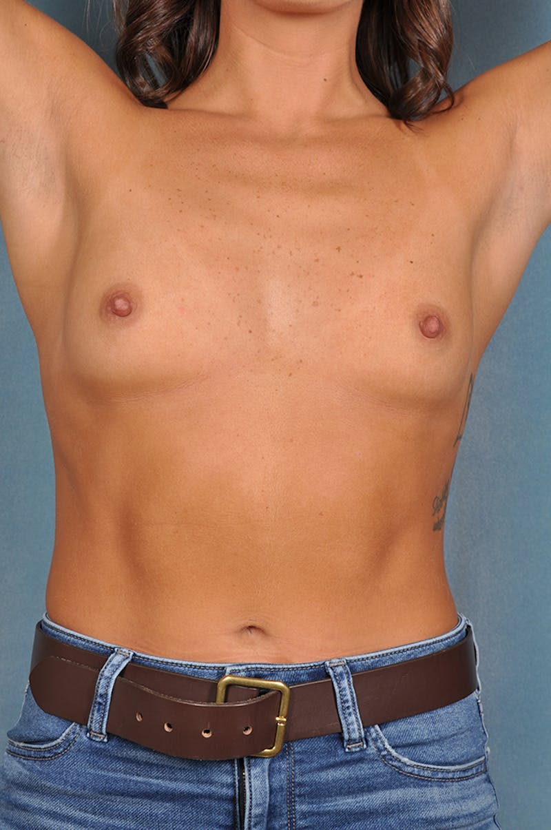 Selfie Gallery Before & After Gallery - Patient 243939 - Image 1