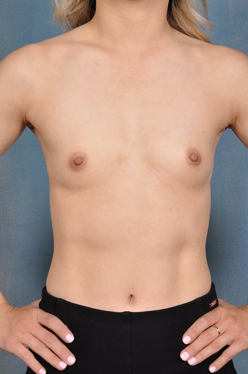 Selfie Gallery Before & After Gallery - Patient 323422 - Image 1