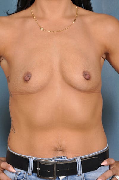 Selfie Gallery Before & After Gallery - Patient 357950 - Image 1