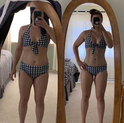 Selfie Gallery Before & After Gallery - Patient 131551 - Image 2