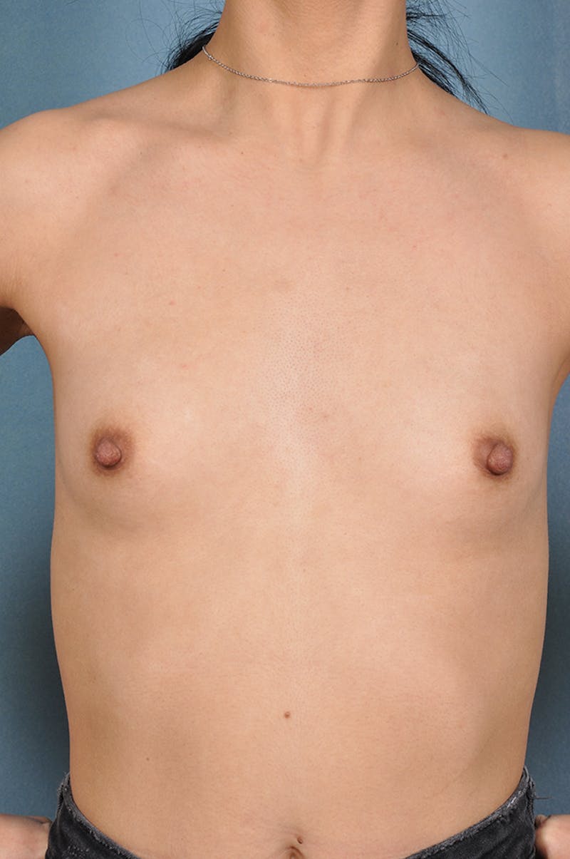 Selfie Gallery Before & After Gallery - Patient 148119 - Image 1