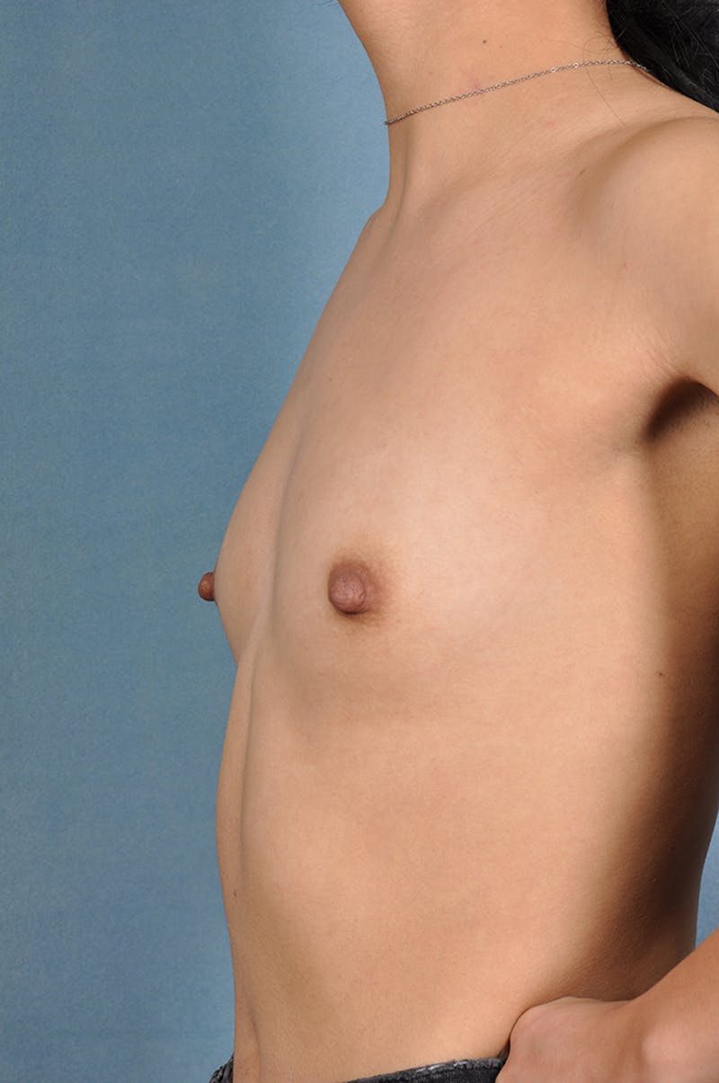 Selfie Gallery Before & After Gallery - Patient 352838 - Image 1