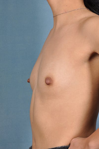 Selfie Gallery Before & After Gallery - Patient 352838 - Image 1