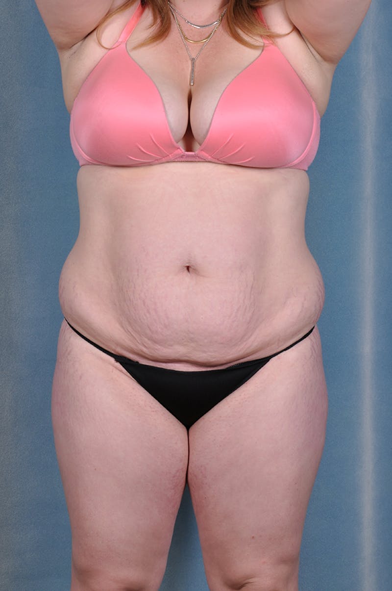 Selfie Gallery Before & After Gallery - Patient 368066 - Image 1