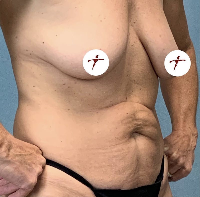Selfie Gallery Before & After Gallery - Patient 819668 - Image 1