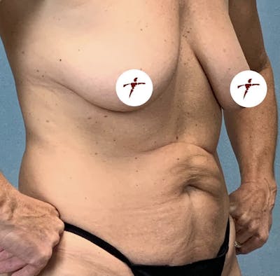 Selfie Gallery Before & After Gallery - Patient 819668 - Image 1