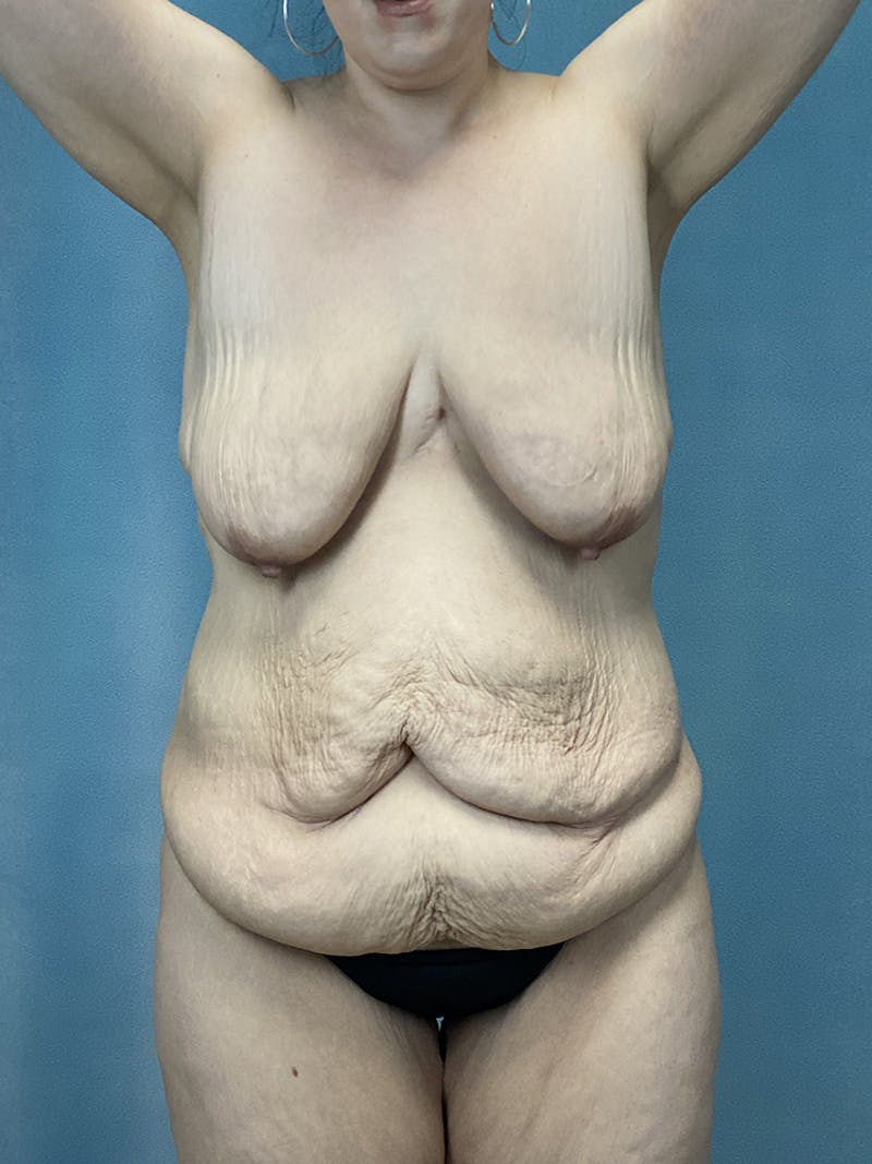 Selfie Gallery Before & After Gallery - Patient 224758 - Image 1