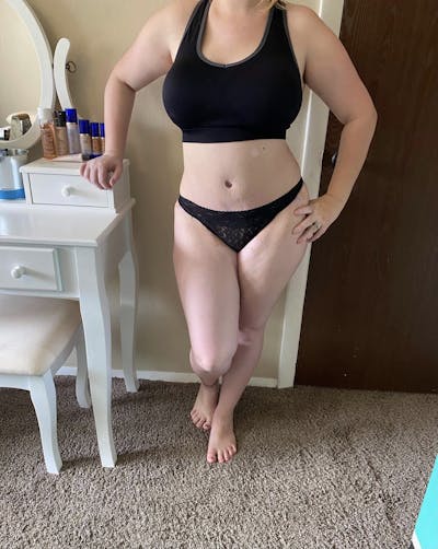 Selfie Gallery Before & After Gallery - Patient 219731 - Image 2