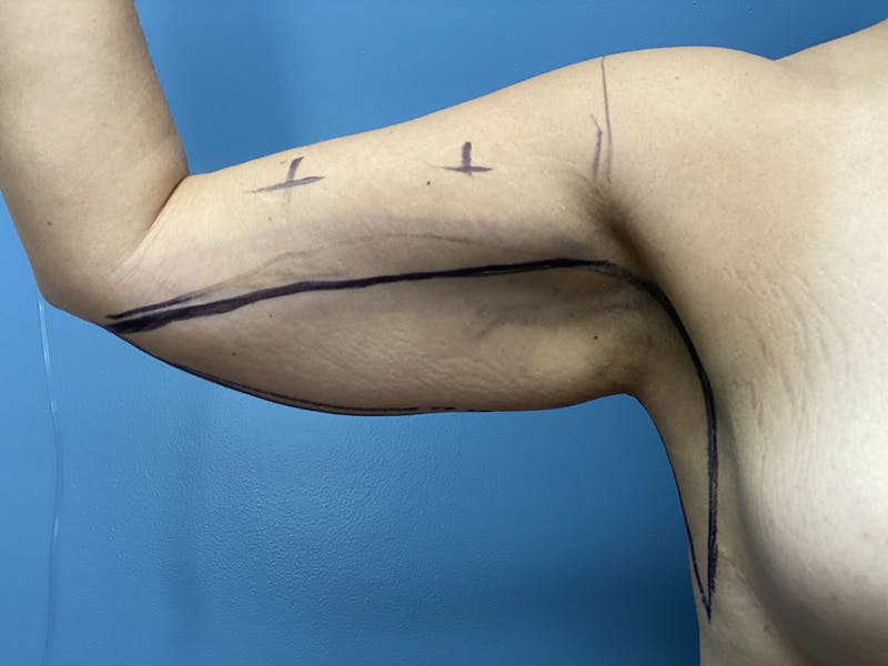 Selfie Gallery Before & After Gallery - Patient 229745 - Image 1
