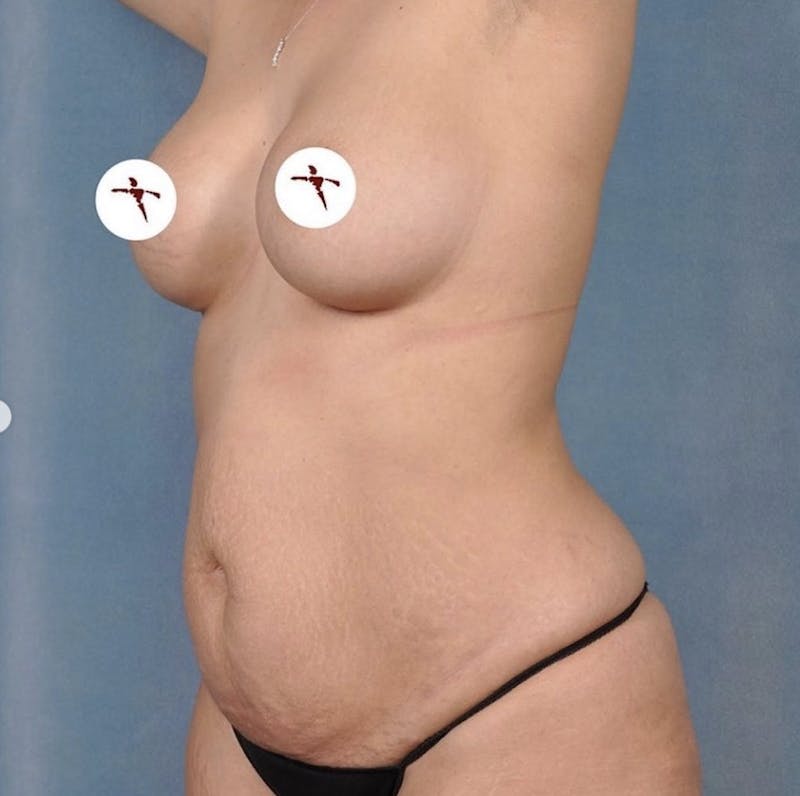 Selfie Gallery Before & After Gallery - Patient 241215 - Image 1