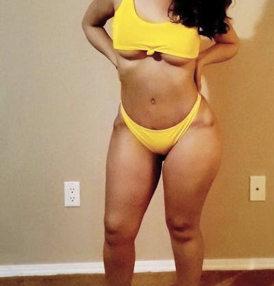 Selfie Gallery Before & After Gallery - Patient 241215 - Image 2