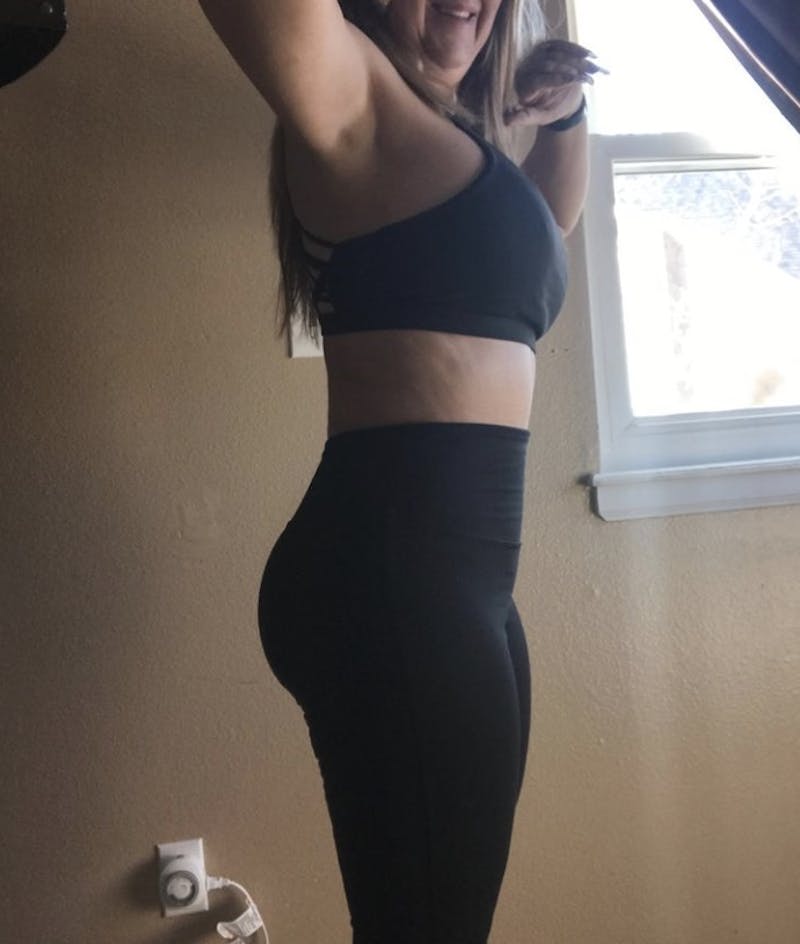 Selfie Gallery Before & After Gallery - Patient 358880 - Image 2