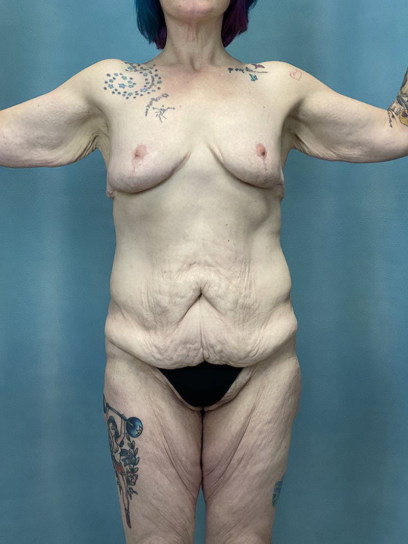 Selfie Gallery Before & After Gallery - Patient 142945 - Image 1