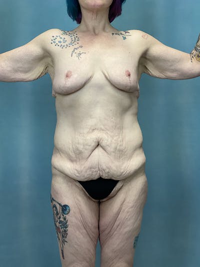 Selfie Gallery Before & After Gallery - Patient 142945 - Image 1