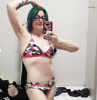 Selfie Gallery Before & After Gallery - Patient 142945 - Image 2