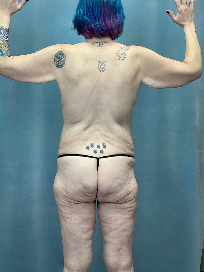 Selfie Gallery Before & After Gallery - Patient 346357 - Image 1