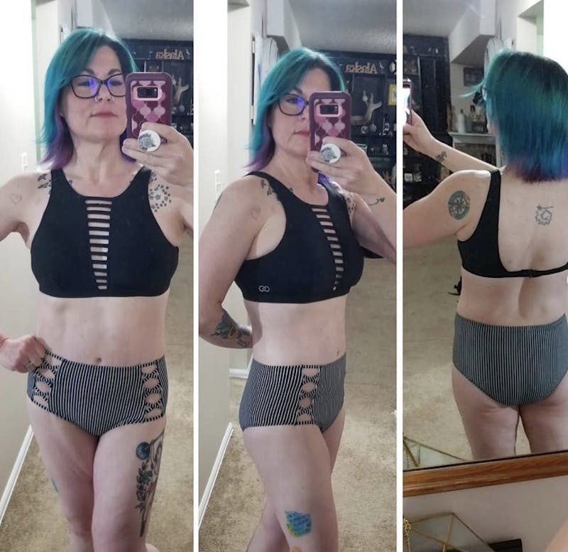 Selfie Gallery Before & After Gallery - Patient 346357 - Image 2