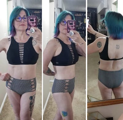 Selfie Gallery Before & After Gallery - Patient 346357 - Image 2