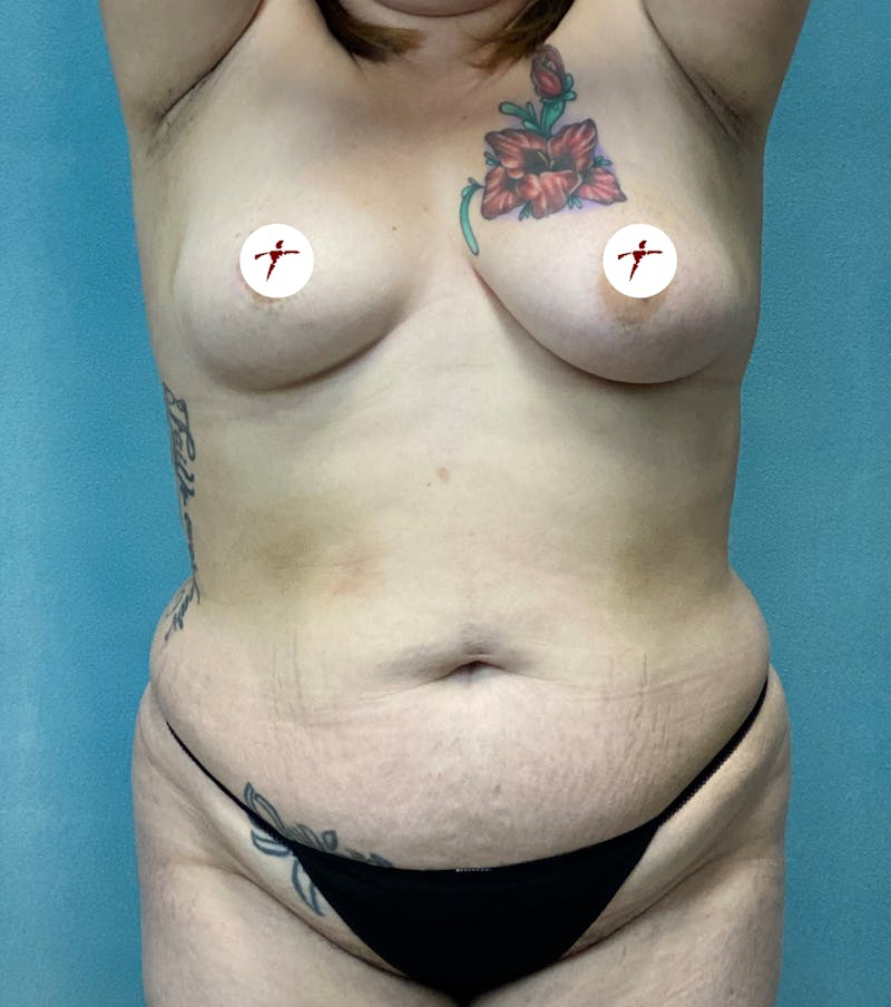 Selfie Gallery Before & After Gallery - Patient 401680 - Image 1