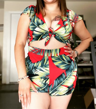 Selfie Gallery Before & After Gallery - Patient 401680 - Image 2