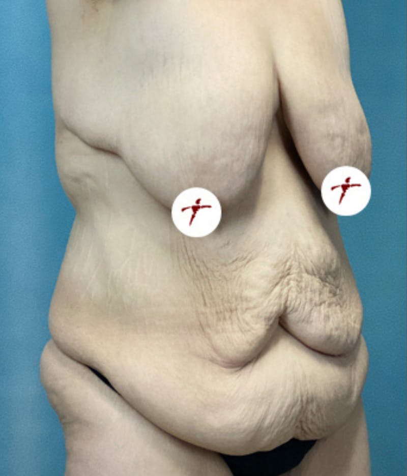 Selfie Gallery Before & After Gallery - Patient 289738 - Image 1