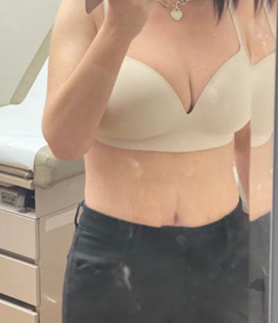 Selfie Gallery Before & After Gallery - Patient 289738 - Image 2