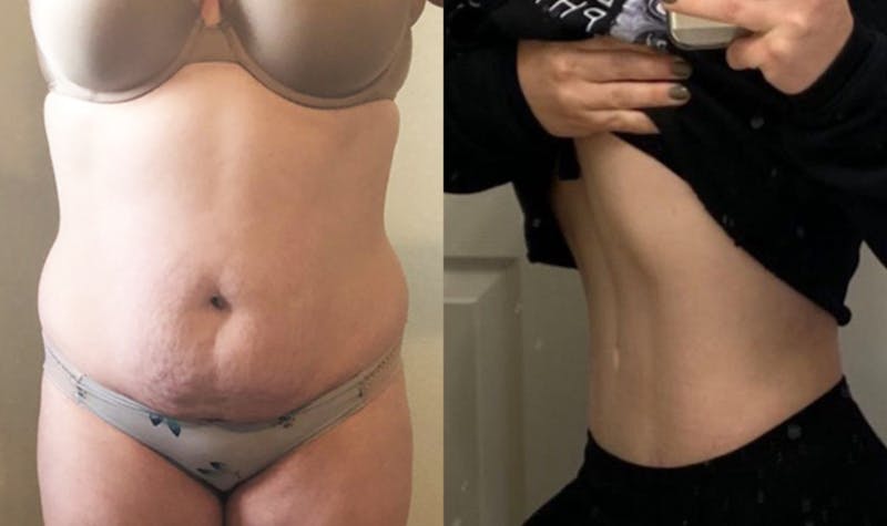 Selfie Gallery Before & After Gallery - Patient 252116 - Image 1