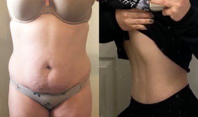 Selfie Gallery Before & After Gallery - Patient 252116 - Image 1