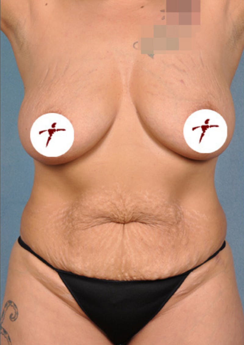 Selfie Gallery Before & After Gallery - Patient 339873 - Image 1