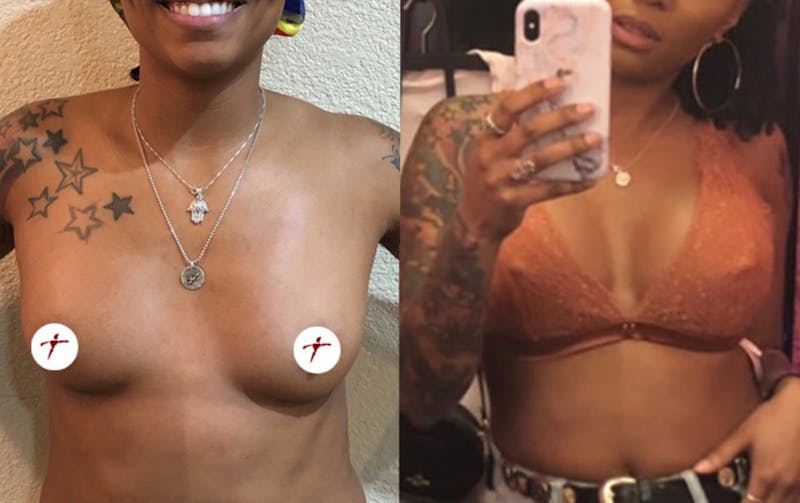 Selfie Gallery Before & After Gallery - Patient 277973 - Image 1