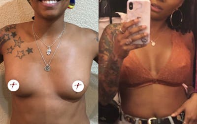 Selfie Gallery Before & After Gallery - Patient 277973 - Image 1