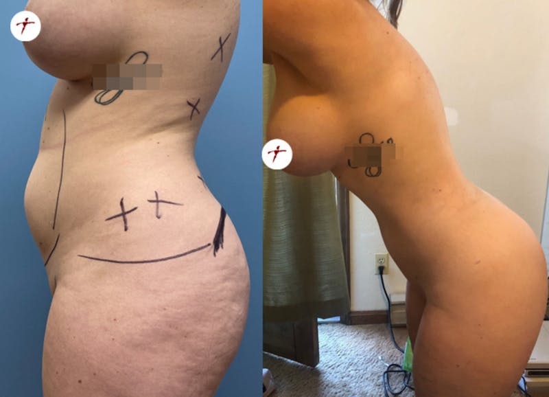 Selfie Gallery Before & After Gallery - Patient 355902 - Image 1